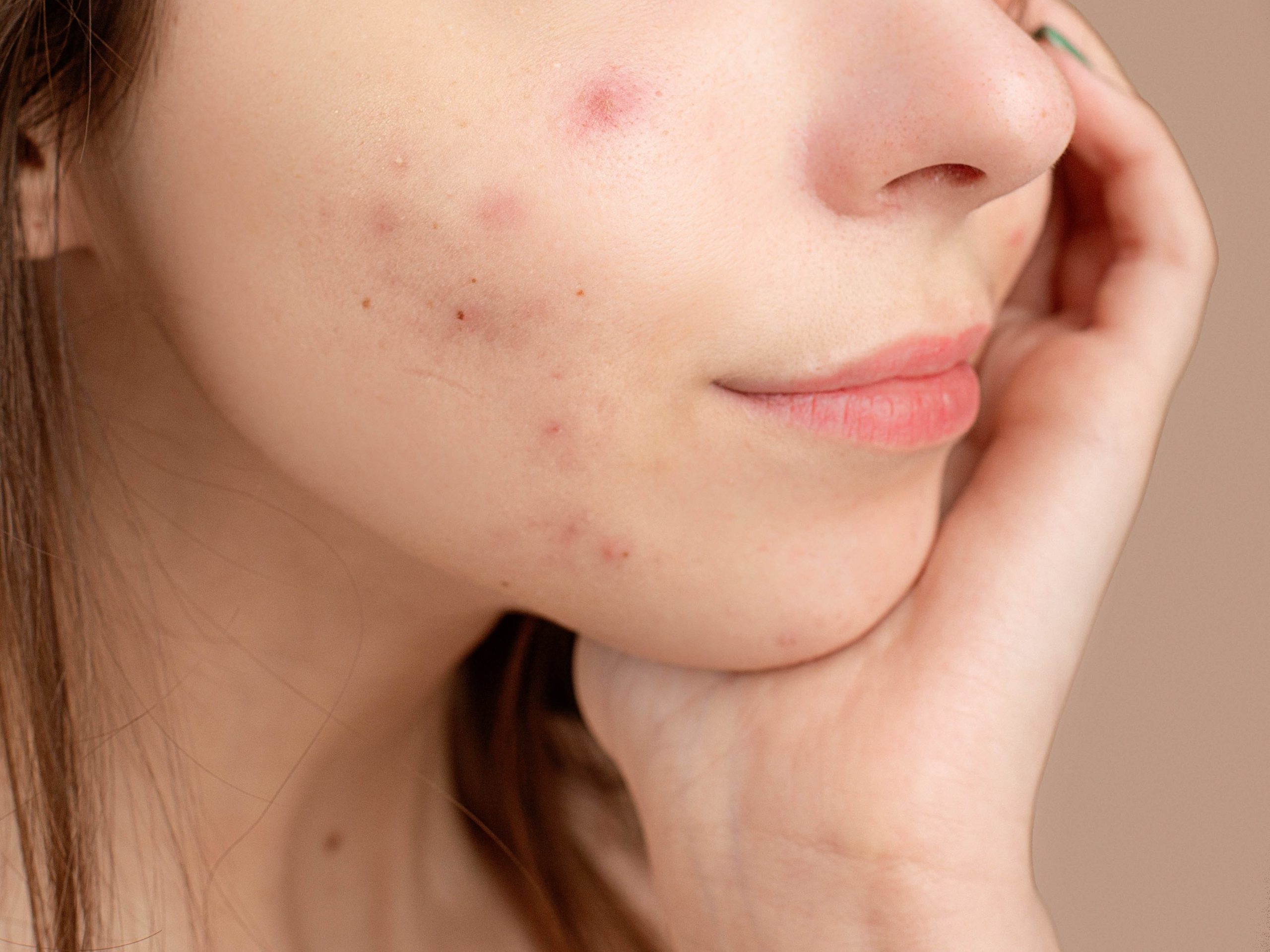 person trying to get rid of acne