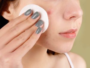 The Best Skincare Ingredients that Fade Acne Dark Spots